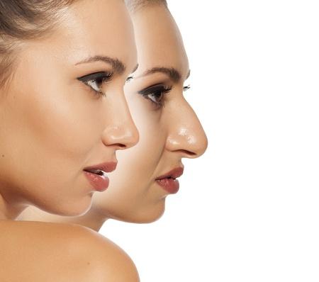 RHINOPLASTIE