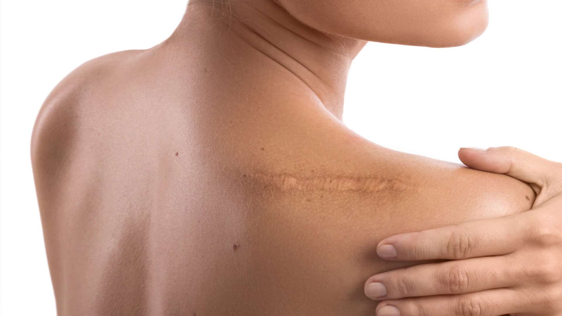 Médecine Laser et Esthétique à Paris Comment se débarrasser d’une cicatrice chéloïde