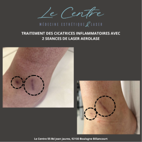 aerolase-traitement-des-cicatrices-inflammatoires-avec-2-seances