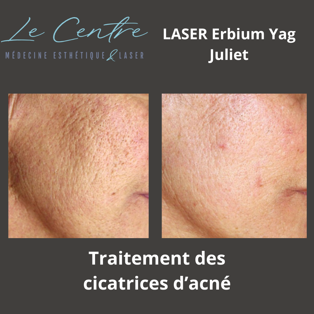 juliet-cicatrices-dacne