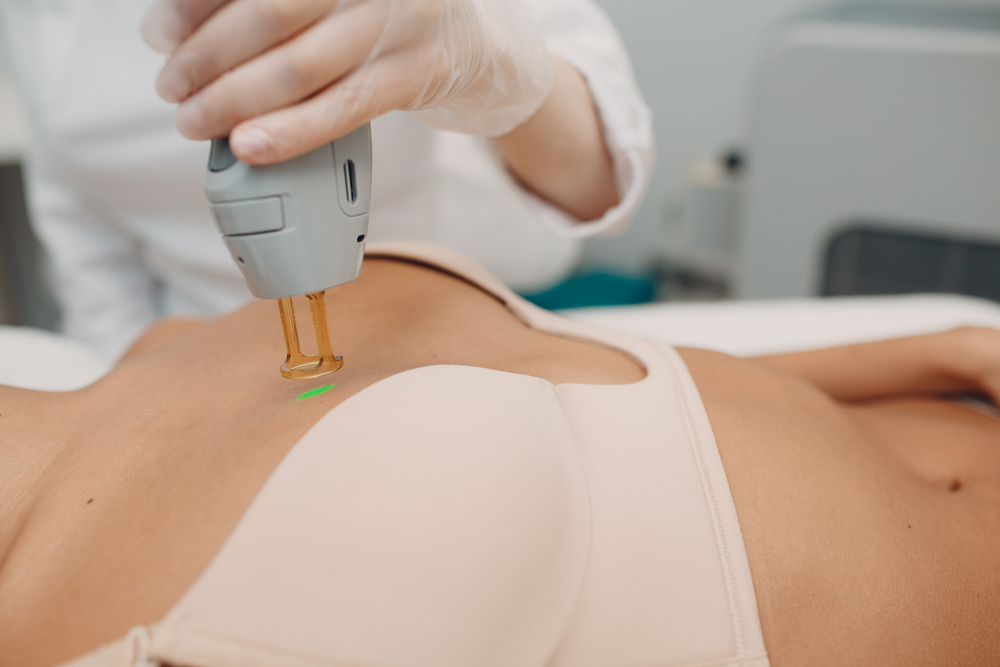 Epilation laser seins