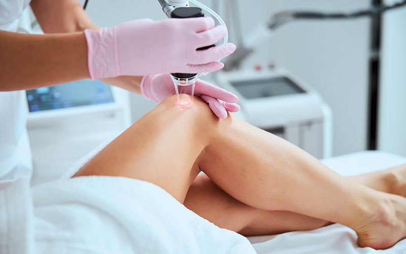 лазер для борьбы с варикозными звездочками на ногах