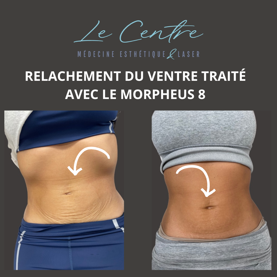 relachement-ventre-malek-avant-apres