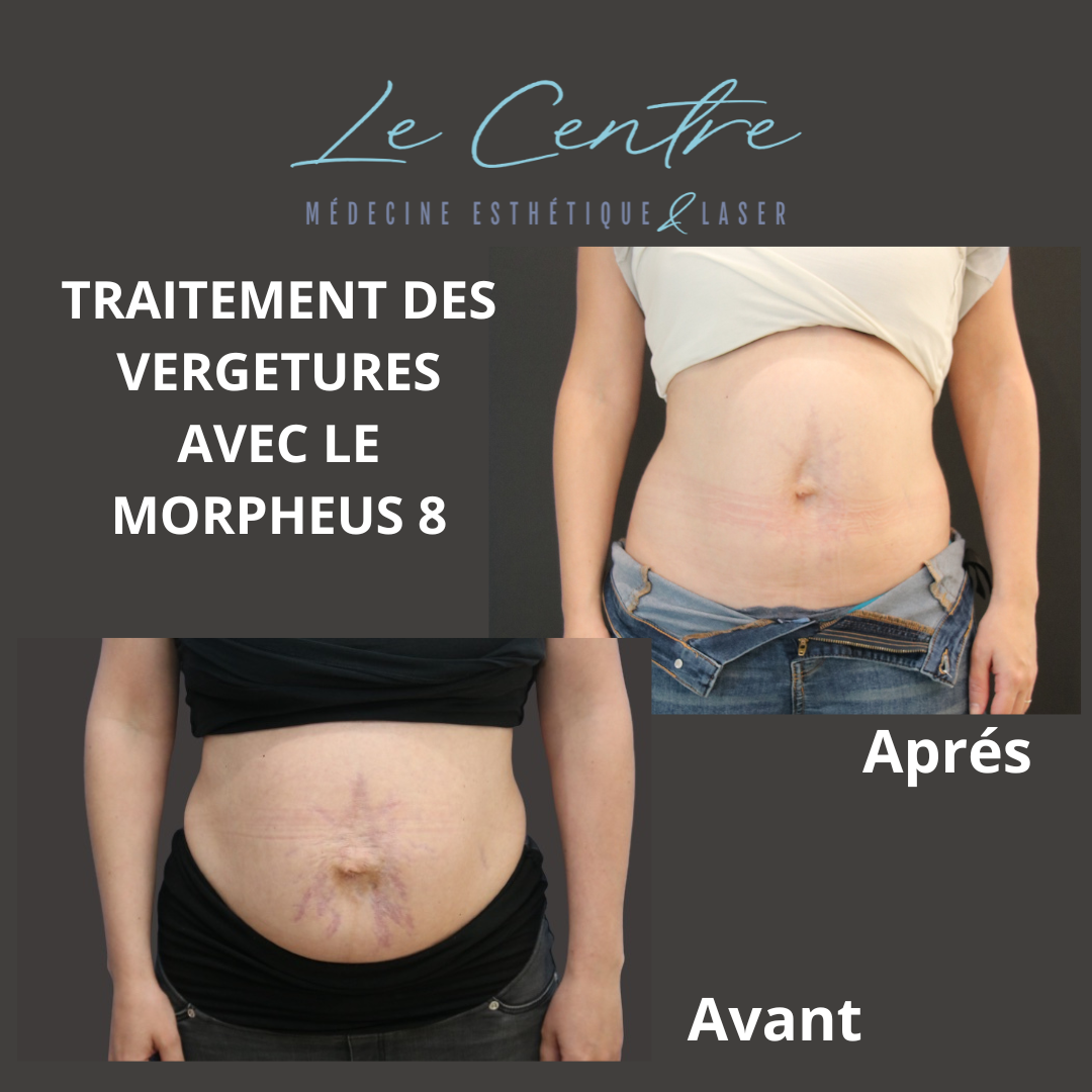 vergetures-morpheus-av-apres