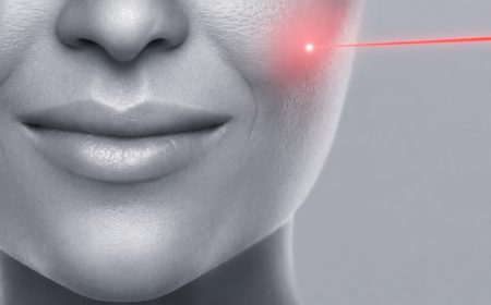 Epilation laser favoris