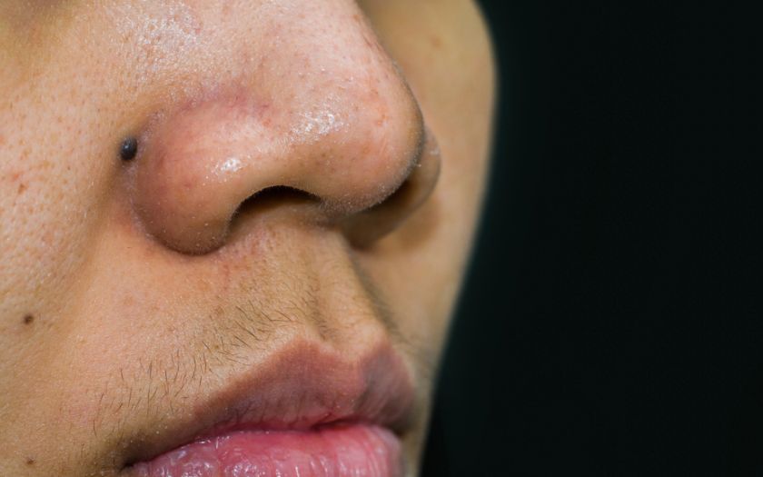 Epilation laser levre superieure