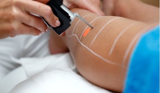 Epilation Laser des cuisses