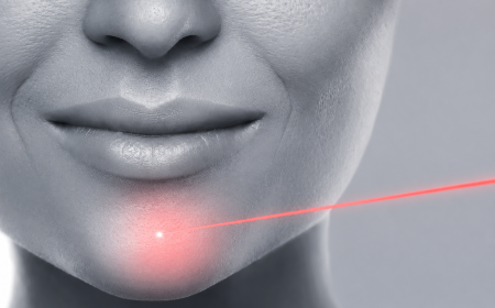 Epilation laser menton