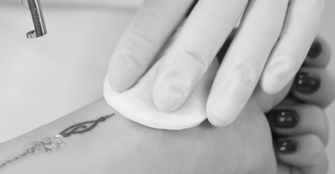 лазерное удаление татуировок Париж