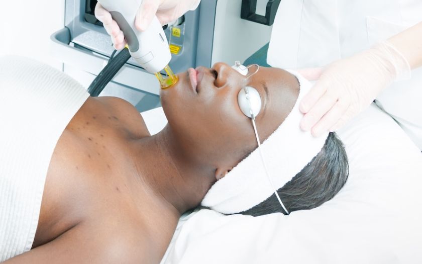 Epilation laser du Visage