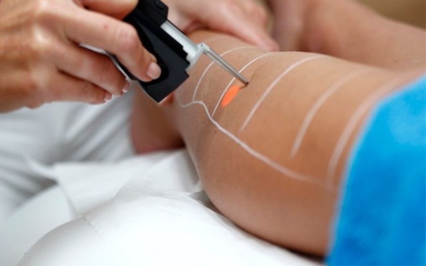 Epilation Laser des cuisses