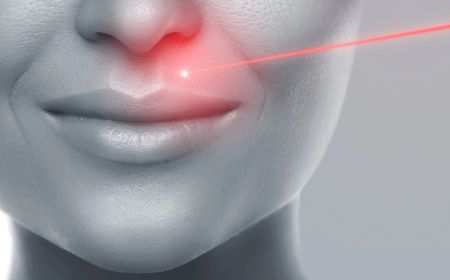 Epilation laser lèvre supérieure