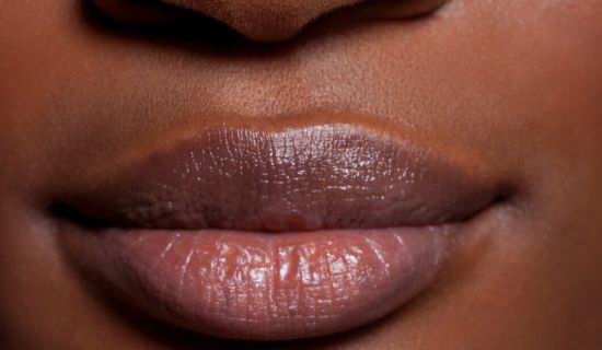 Laser hair removal for the upper lip