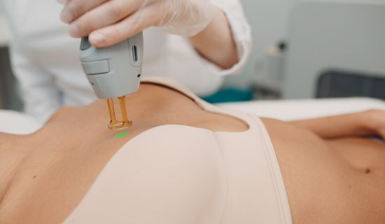 Epilation laser seins