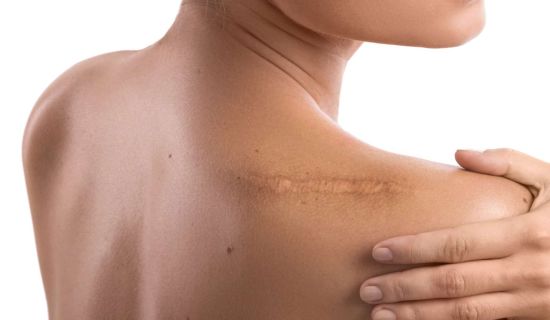 treatment of a keloid scar