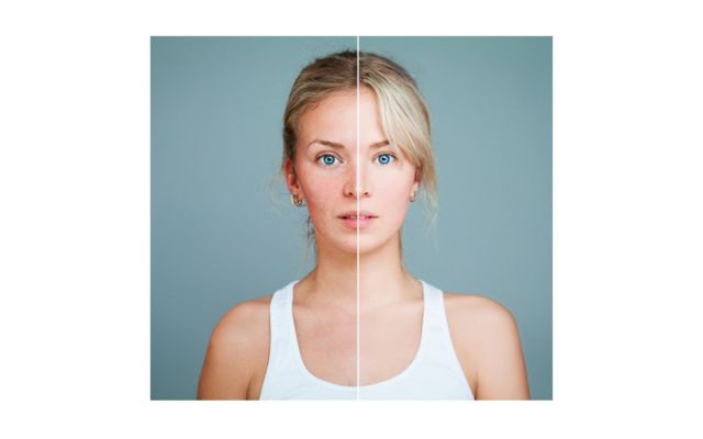 Le principe du laser vasculaire