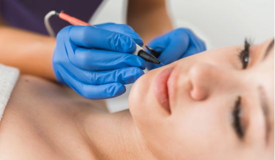 Epilation electrique