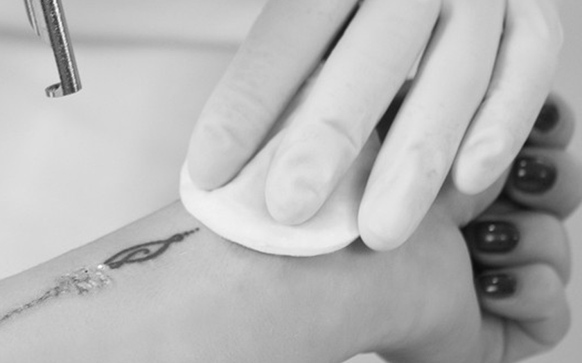 detatouage laser paris