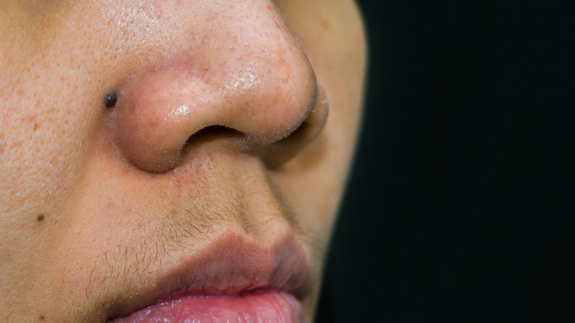 Epilation laser levre superieure