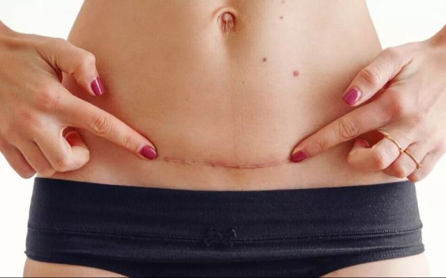 Comment éclipser la cicatrice post césarienne ?