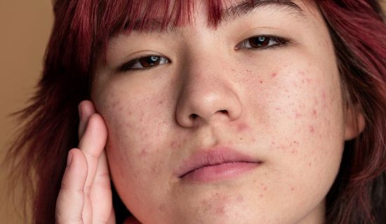 rosacea: What treatments?