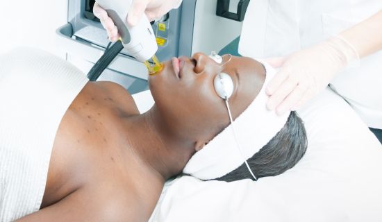Epilation laser du Visage