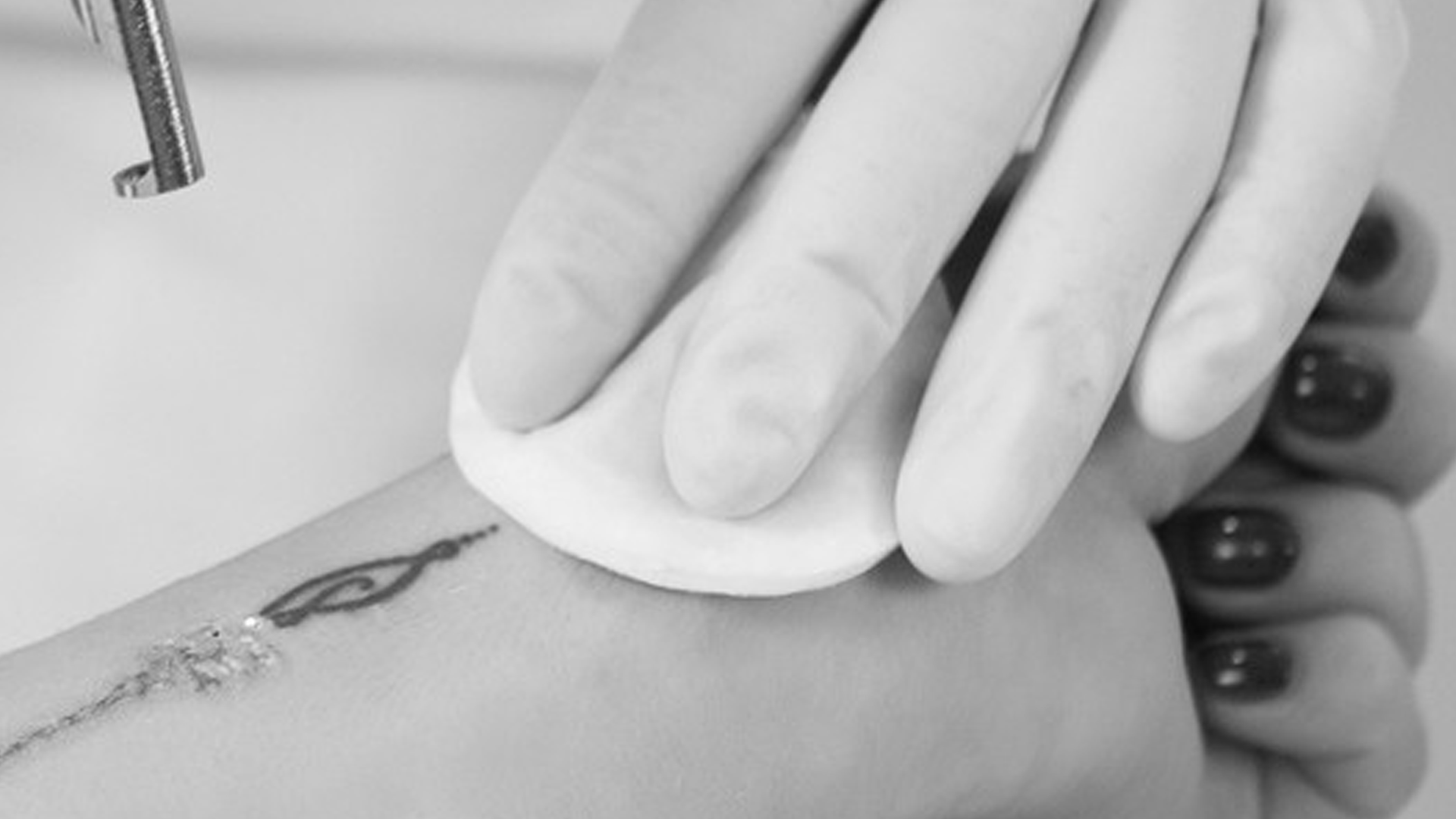 detatouage laser paris