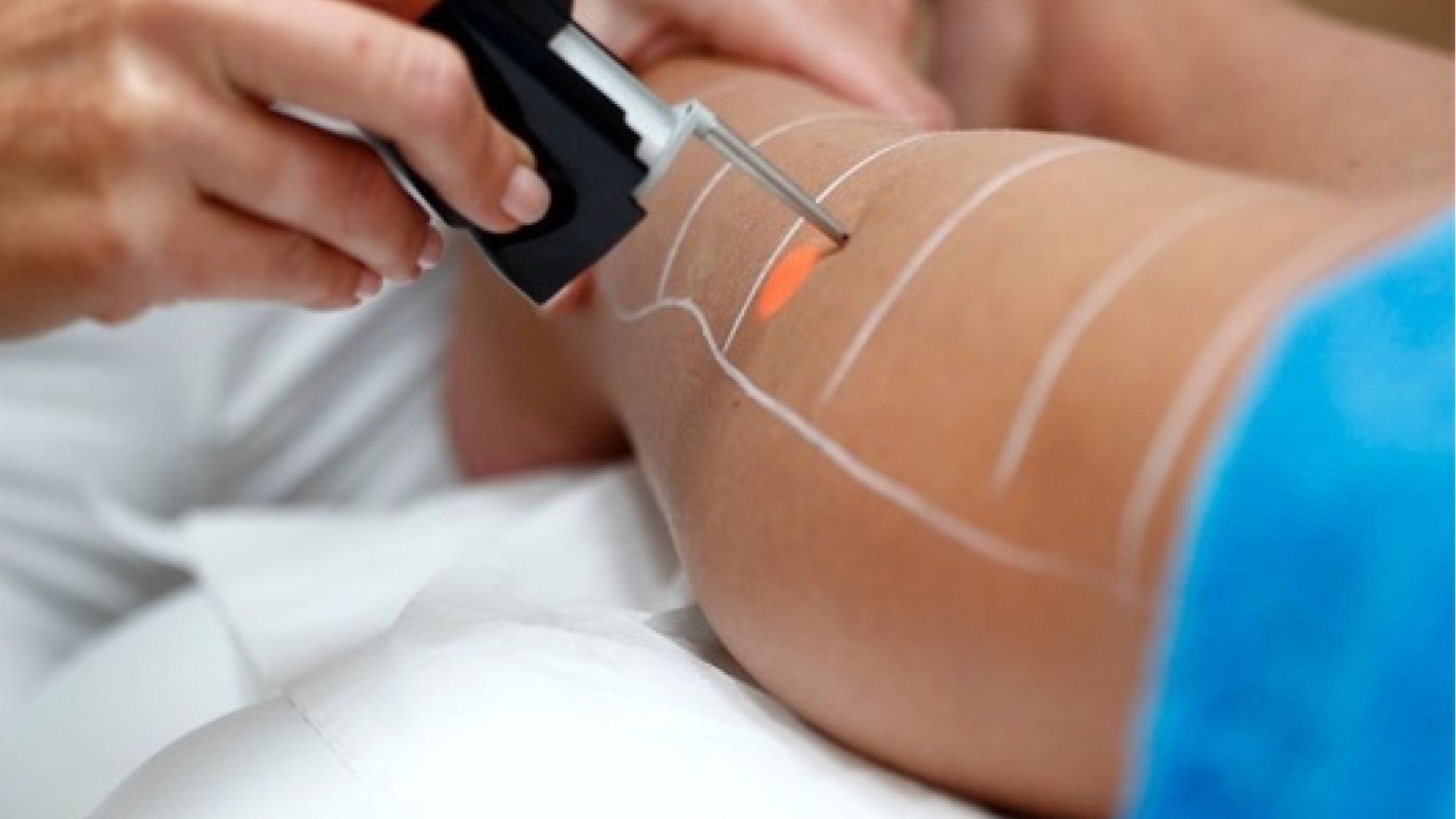 Epilation Laser des cuisses