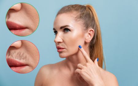 Hirsutism