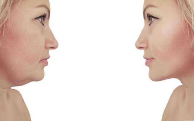 Faire fondre son double menton grâce à la lipocryothérapie