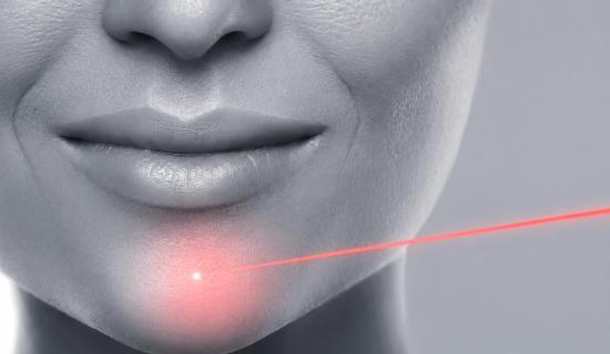 إزالة الشعر بالليزر للذقن