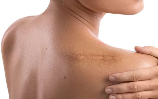 Comment se débarrasser d’une cicatrice chéloïde ?