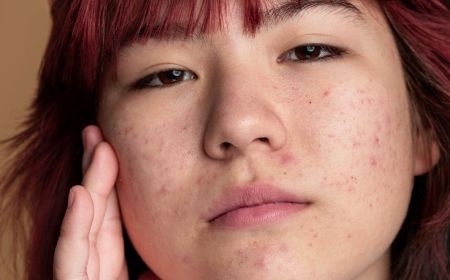 acné rosacée: Quels traitements ?