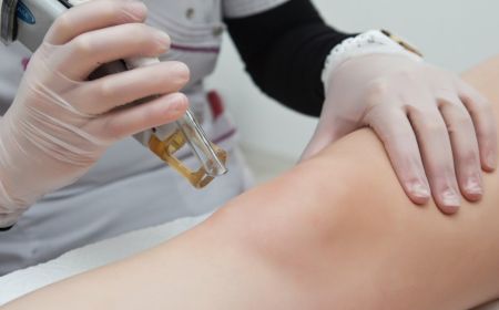 Epilation laser à Paris